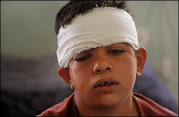 Imran, 12, lays injured and bandaged at Wazir Akbar Khan Hospita after a car bomb exploded in front of the NATO headquarters, in Kabul, Afghanistan.